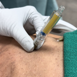 Capnospot pneumothorax detector Capnospot pneumothorax detector