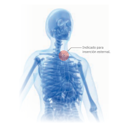 Sternal intraosseous system Fast1 Sternal intraosseous system Fast1