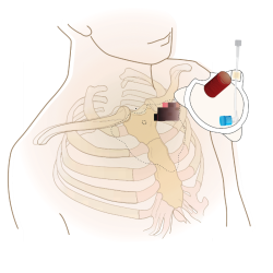 Sternal intraosseous system Fast1 Sternal intraosseous system Fast1