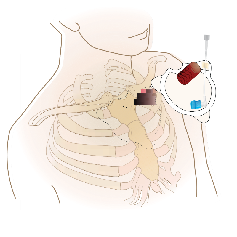 Sternal intraosseous system Fast1 Sternal intraosseous system Fast1