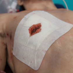 Apósito Torácico Russel | IES Medical Shop Apósito Torácico Russel | IES Medical Shop