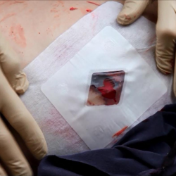 Apósito Torácico Russel | IES Medical Shop Apósito Torácico Russel | IES Medical Shop