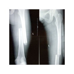 Traction splint CT-6 EMS | IES Medical Shop