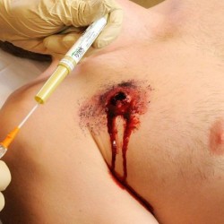 Thoracic decompression needle Tpak Thoracic decompression needle Tpak